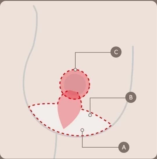 Diagram showing the incision and lift directions in a breast lift