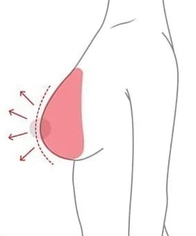 Side-view diagram showing the upward direction in which sagging tissue is lifted