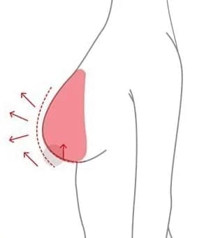 Diagram showing how tissue is gathered and lifted to reshape the breast
