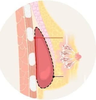 Cross-section diagram showing the extent of partial capsule removal