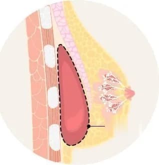 Cross-section diagram showing the extent of total capsule removal