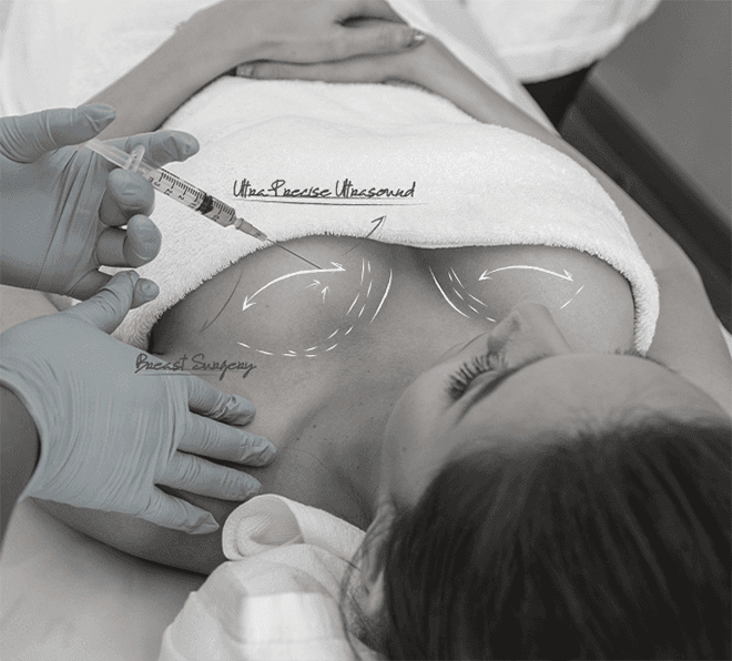 U&U breast biopsy with Mammotome — tissue sampling under ultrasound guidance