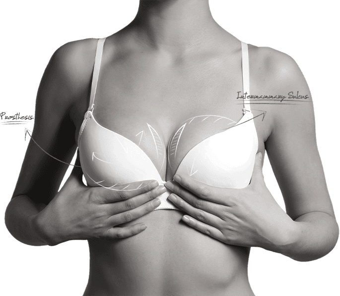 U&U brassiere education — guidance on wearing a bra after breast surgery