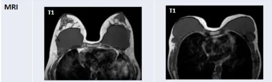 Ruptured Breast Implant: Do You Always Need an MRI? Can It Be Checked with Ultrasound Instead? — article image 6