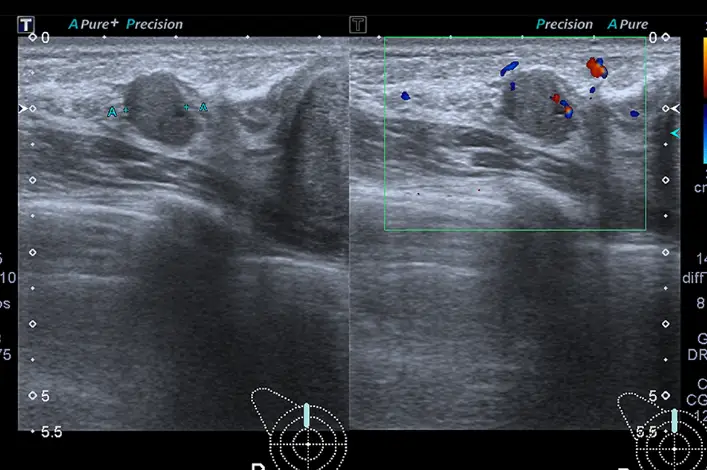 Hybrid Breast Augmentation — Implants vs. Fat Grafting? A Letter to Those Standing at a Crossroads — article image 12