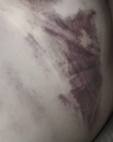 Breast Surgery Recovery: 2 Complications That Can Set It Back More Than 1 Week — Advice from 20 Years of Research — 본문 이미지