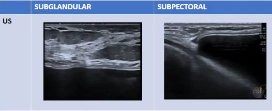 Ruptured Breast Implant: Do You Always Need an MRI? Can It Be Checked with Ultrasound Instead? — article image 5