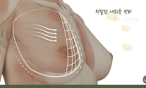 Breast Surgery for Pectus Carinatum: Will I Just Get Bigger with No Cleavage? (Advice from 20 Years of Research) — 본문 이미지