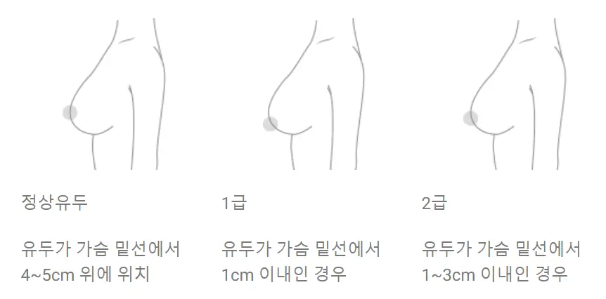 Breast Lift Surgery Cost? Why Looking Up the Price First Is Meaningless. — article image 3