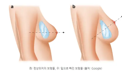 Revision Surgery for Bottoming Out? A Complete Guide by Incision — Armpit vs. Inframammary Fold (Advice from 20 Years of Research) — 본문 이미지