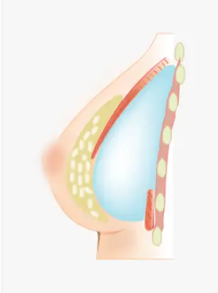 Flat-Chest Breast Augmentation: Will Implants Look Too Obvious? <Advice Based on Actual Research> — article image 5