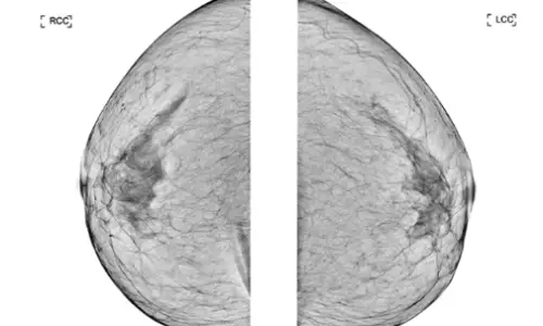Breast Surgery and Breastfeeding? A Complete Guide by Procedure — Augmentation, Reduction, and Lift <Advice from a Clinic with a Board-Certified Breast Surgeon> — article image 11