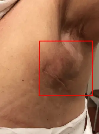 Breast Surgery Recovery: 2 Complications That Can Set It Back More Than 1 Week — Advice from 20 Years of Research — 본문 이미지
