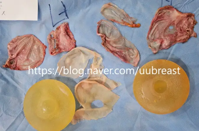 Capsule Removal? When the Cost Can Differ by About 2x (Advice from 20 Years of Research) — 본문 이미지