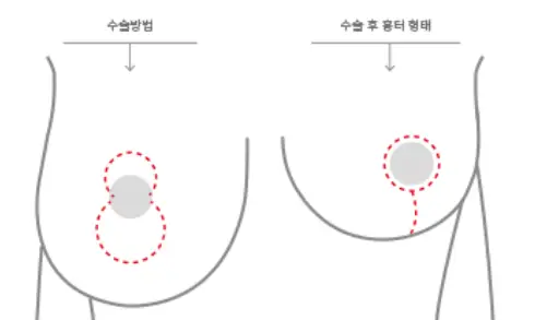 Sagging Breast Surgery Cost — Including When a Lift or Implants Are Needed <Advice from 20 Years of Research Experience> — article image 5