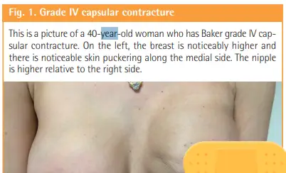 Capsular contracture: when does it occur, and what are the symptoms? Insights from an analysis of 82 papers. — article image 7