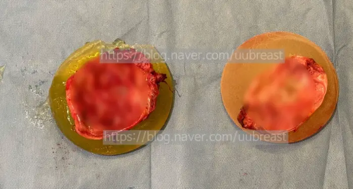 Capsule Removal? When the Cost Can Differ by About 2x (Advice from 20 Years of Research) — 본문 이미지