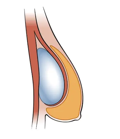 Sagging Breasts After Childbirth: The Misconception That Filling Only the Upper Breast with an Implant Is Enough? — article image 5