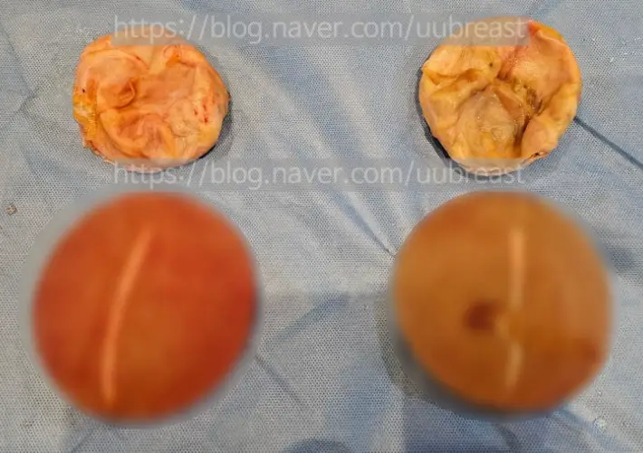 Capsule Removal? When the Cost Can Differ by About 2x (Advice from 20 Years of Research) — 본문 이미지