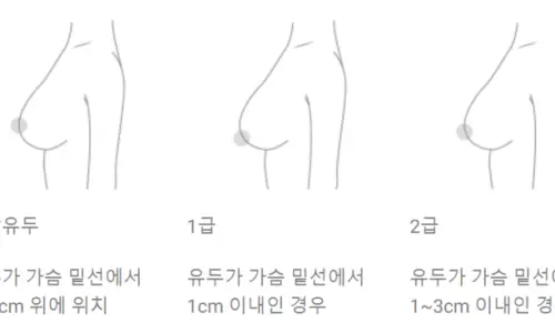 Sagging Breast Surgery Reviews? Don't Be Fooled. — article image 12