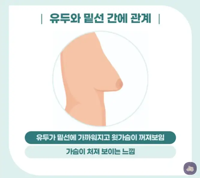 Breast Lift Cost and Price? Answers from a Clinic That Performed 3023 Breast Implant Surgeries Last Year Alone. — article image 5