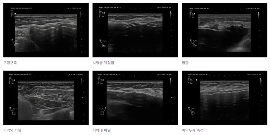 Aftercare Following Breast Surgery: Can You Get It from Out of Town? Will You Need Frequent Visits? — 본문 이미지