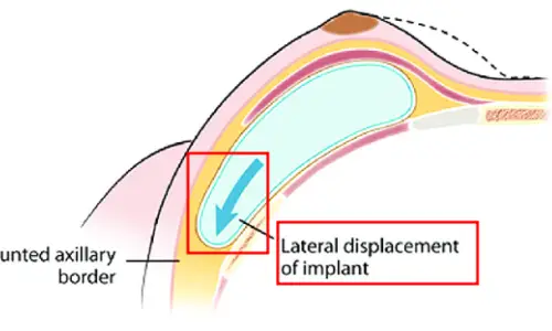 Revision Surgery for Bottoming Out? A Complete Guide by Incision — Armpit vs. Inframammary Fold (Advice from 20 Years of Research) — 본문 이미지