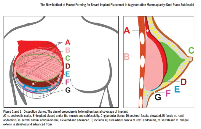 Flat-Chest Breast Augmentation: Will Implants Look Too Obvious? <Advice Based on Actual Research> — article image 6