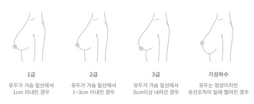 Sagging Breasts After Childbirth: The Misconception That Filling Only the Upper Breast with an Implant Is Enough? — article image 6
