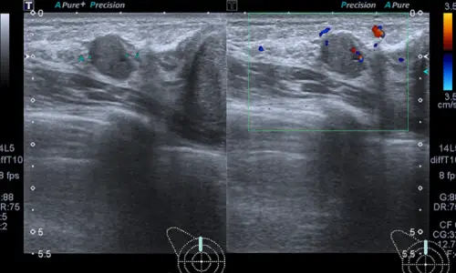 Capsule Removal? When the Cost Can Differ by About 2x (Advice from 20 Years of Research) — 본문 이미지