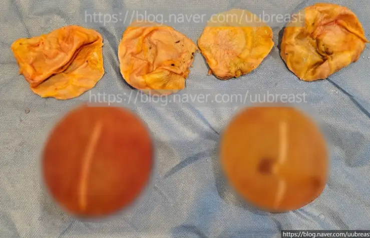 Capsule Removal? When the Cost Can Differ by About 2x (Advice from 20 Years of Research) — 본문 이미지