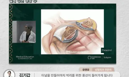 Motiva Preservé Price? Answers from the Clinic That Used the Most Motiva Implants Last Year — 본문 이미지
