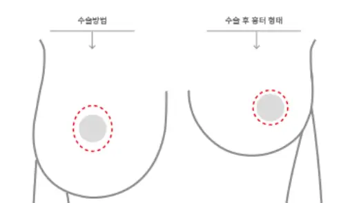 Sagging Breast Surgery Cost — Including When a Lift or Implants Are Needed <Advice from 20 Years of Research Experience> — article image 6