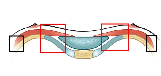 Breast Surgery for Pectus Carinatum: Will I Just Get Bigger with No Cleavage? (Advice from 20 Years of Research) — 본문 이미지