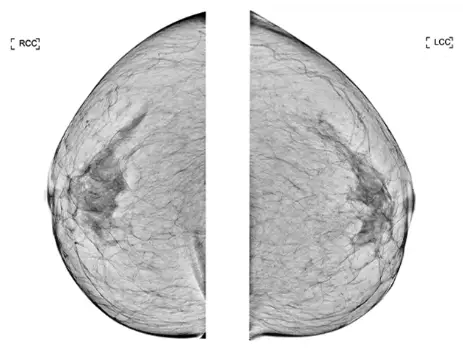 Breast Surgery and Breastfeeding: Any Problems? Won't the Implant Weight Leave My Breasts Sagging by the Time I Finish Nursing? — article image 9
