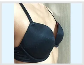 Before breast surgery, side photo 3