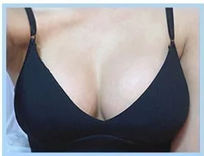 3 weeks after breast surgery, photo 4