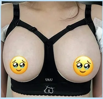Day 2 after breast surgery, front photo in the compression bra 2