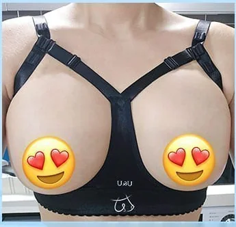Day 2 after breast surgery, front photo in the compression bra 6