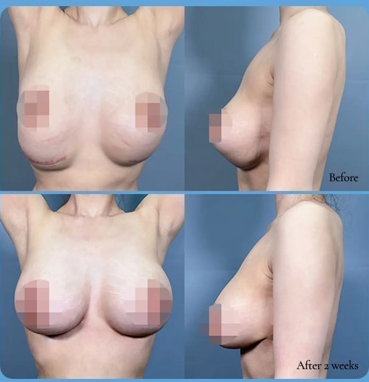 Before-and-after comparison of bottoming-out revision — Before / After 2 weeks (front and side)