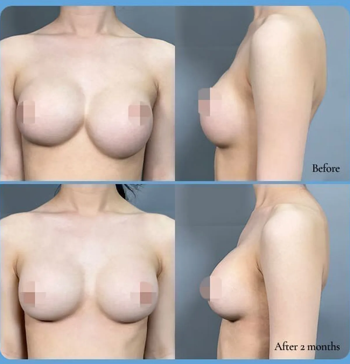 Before-and-after comparison of symmastia (front displacement) and bottoming-out revision — Before / After 2 months (front and side)