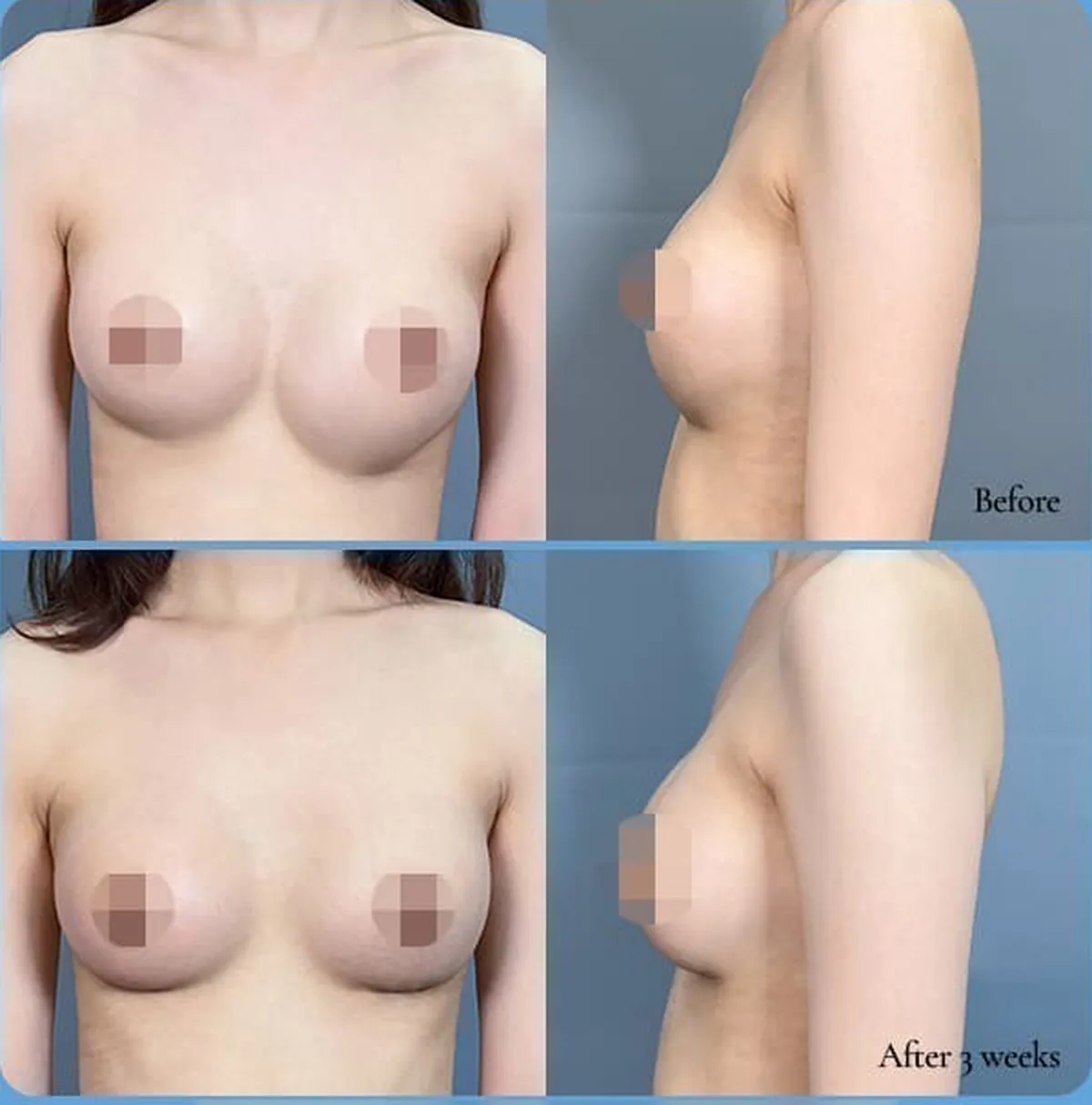 Before-and-after comparison of revision for asymmetry caused by bottoming out — Before / After 3 weeks (front and side)