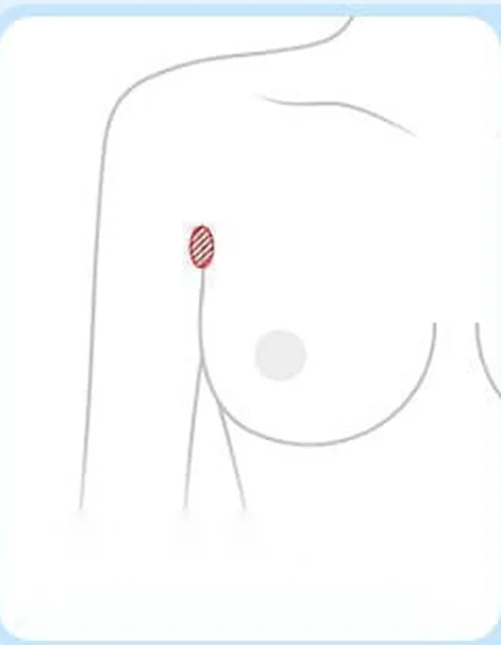 Diagram showing the location of the axillary incision
