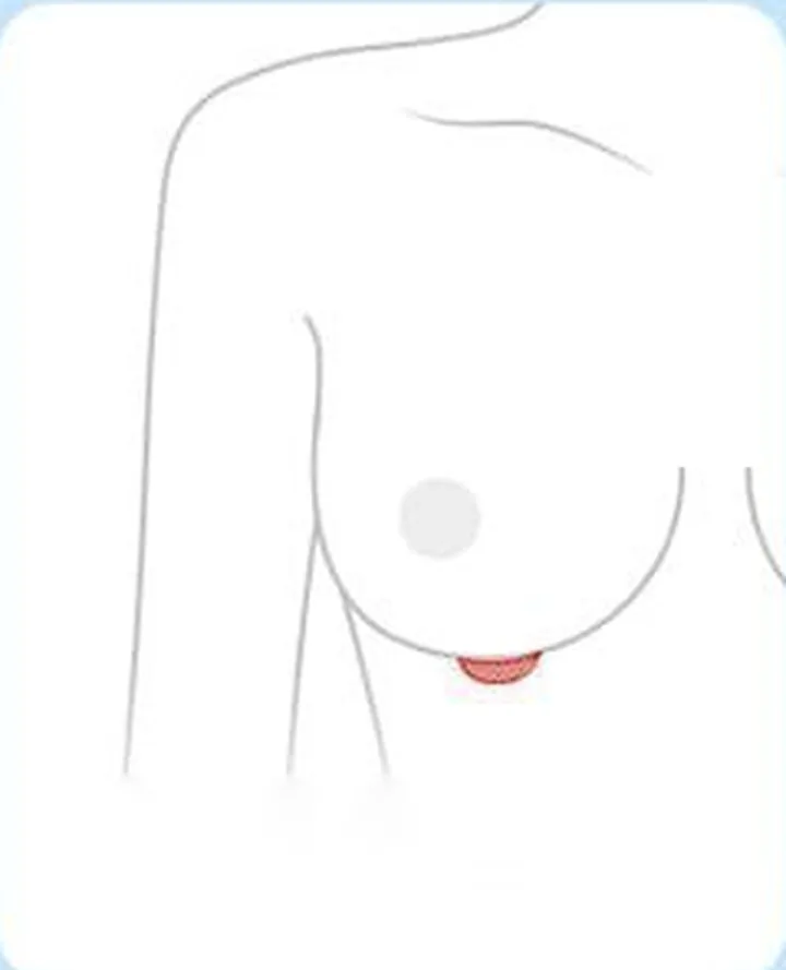 Diagram showing the location of the inframammary fold incision
