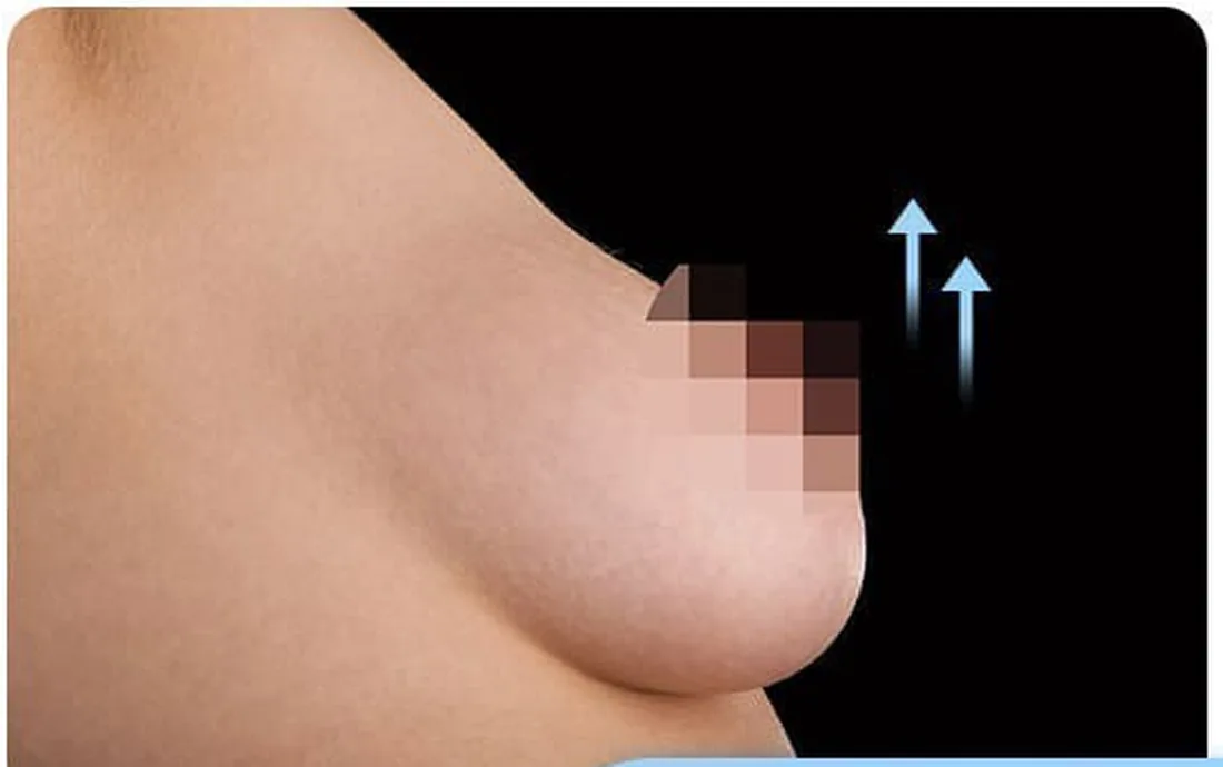 Side view of a breast with bottoming out — the inframammary fold has dropped