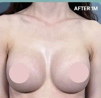 Front photo 1 month after the cleavage refinement procedure