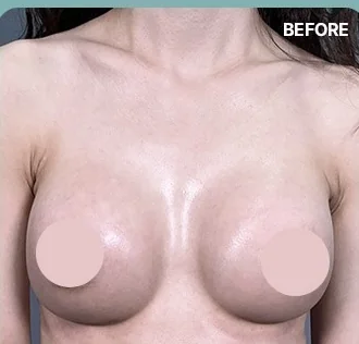 Front photo before the cleavage refinement procedure