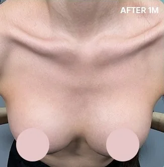 Upper breast photo 1 month after the rippling improvement procedure
