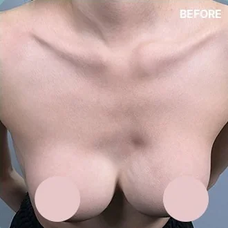 Upper breast photo before the rippling improvement procedure