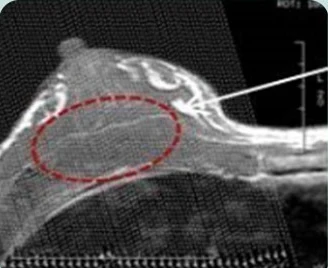 Lateral CT image of the breast — with the injection site marked